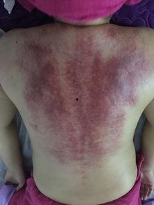 成人背部刮痧视频播放,揭秘成人背部刮痧神奇疗效-第1张图片-草莓福利影院